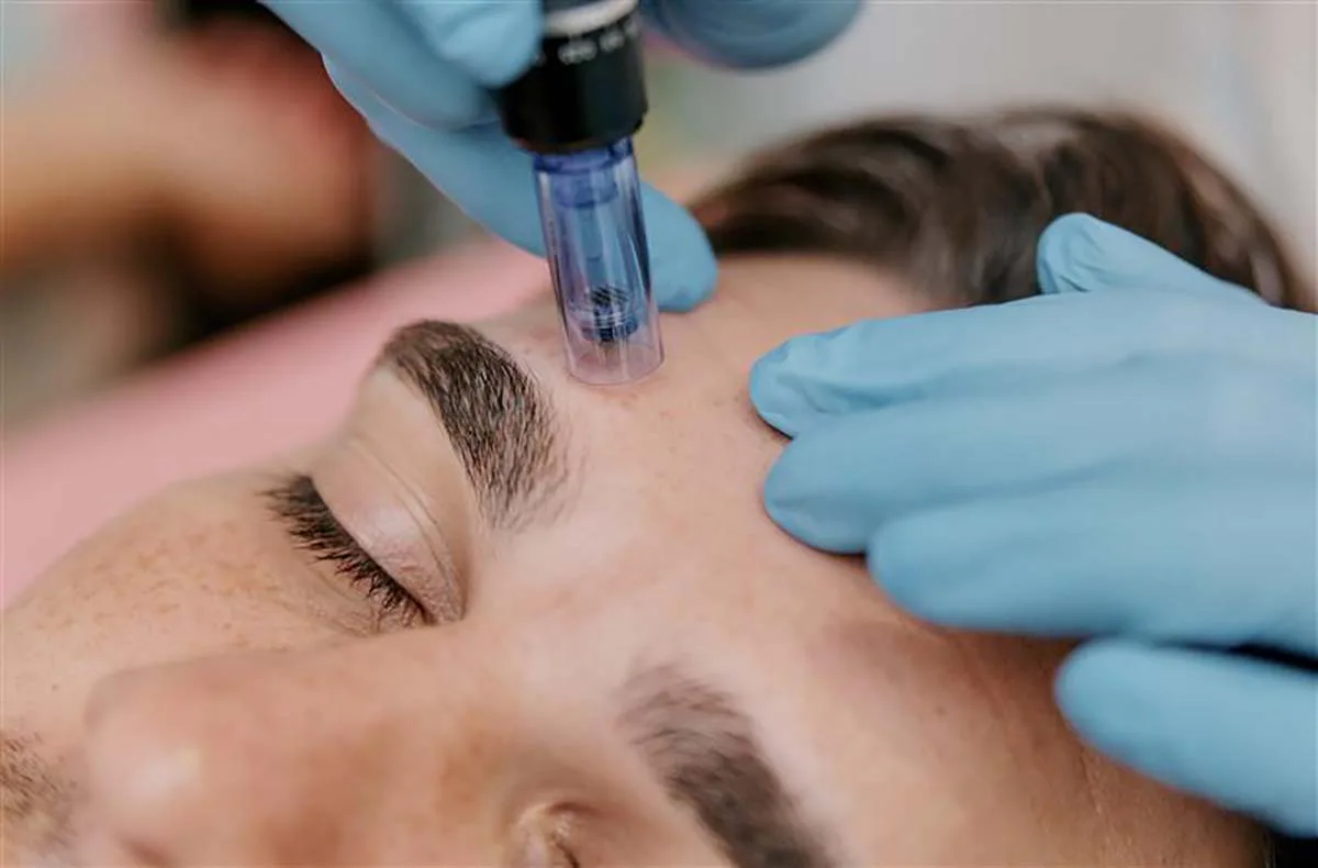 Microneedling Ingolstadt - 1