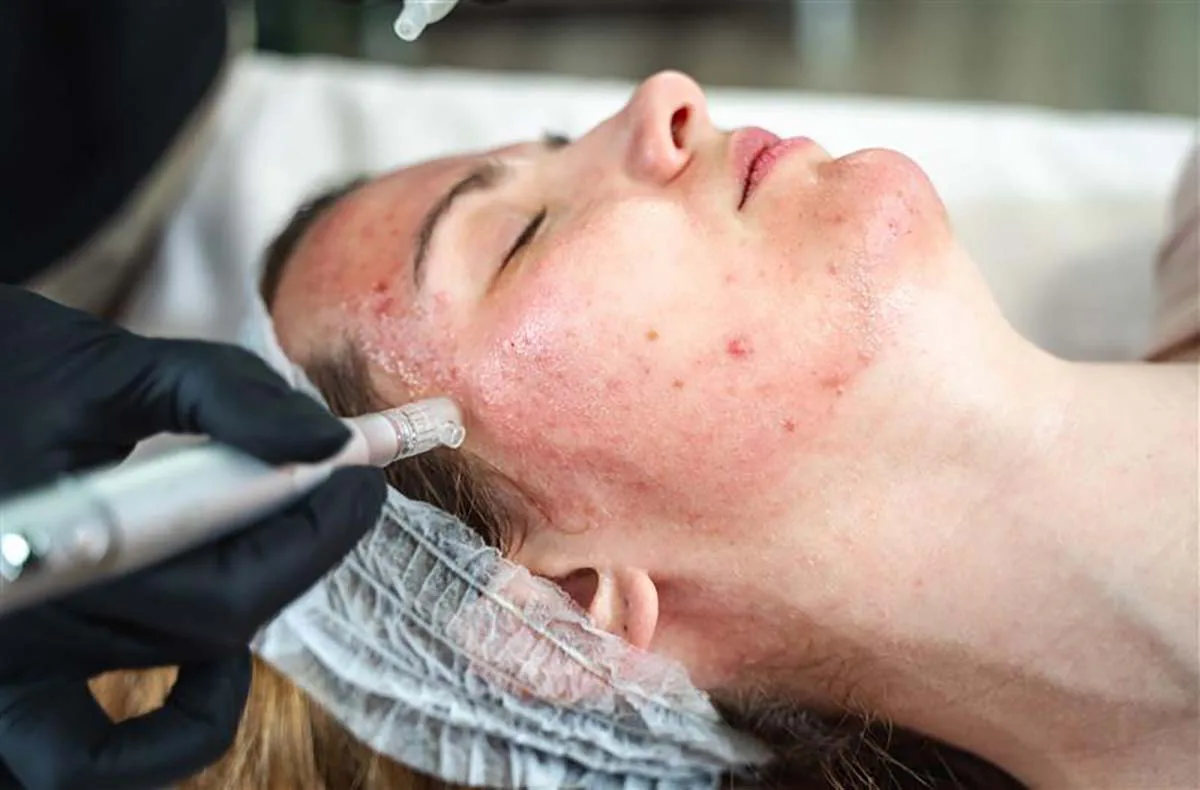 Microneedling Ingolstadt - 3